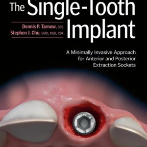 The replacement of the single tooth with a dental implant is one of the most common clinical situations practitioners face on a daily basis. While in the past sockets were left untouched for months after tooth extraction before attending to the residual ridge, today it is possible to perform "one surgery, one time," which is a huge benefit to both the patient and clinician alike. Written by two world-class masters, this book begins with a discussion of the history and rationale for anterior and posterior single-tooth implants, and then it walks the reader through the three types of sockets—type 1, type 2, and type 3—and their various indications and limitations.