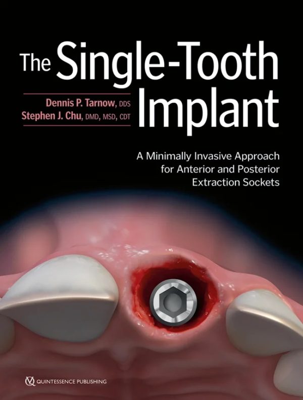 The replacement of the single tooth with a dental implant is one of the most common clinical situations practitioners face on a daily basis. While in the past sockets were left untouched for months after tooth extraction before attending to the residual ridge, today it is possible to perform "one surgery, one time," which is a huge benefit to both the patient and clinician alike. Written by two world-class masters, this book begins with a discussion of the history and rationale for anterior and posterior single-tooth implants, and then it walks the reader through the three types of sockets—type 1, type 2, and type 3—and their various indications and limitations.