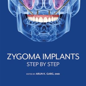 With success rates ranging from 95% to over 98%, zygoma implants are the standard of care in the treatment of patients with severe maxillary bone atrophy who cannot be rehabilitated with surgical bone augmentation and/or the placement of conventional or tilted implants. Because patients who qualify as candidates for zygoma implant therapy usually get only one chance to regain their masticatory function, the stakes for this treatment are very high, and that is why Dr Arun K. Garg undertook this project. Written by distinguished authors with decades of clinical knowledge, the book equips the experienced implant surgeon with comprehensive knowledge of every facet of the surgical and prosthetic treatment protocols for zygoma implant therapy, from patient evaluation and selection to step-by-step procedures and the management of complications, building the reader’s knowledge from start to finish. Learn the ins and outs of zygoma implant therapy so you too can deliver this life-changing therapy to your patients.