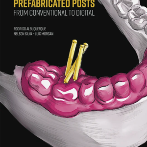 This concise and exquisitely illustrated book, based on the philosophy and clinical experience of its authors and on sound scientific evidence, is divided into 10 chapters in a didactic sequence to make it easier for dentists to apply the techniques in every day practice. The focus is on preserving the heathy tooth structure as much as possible using both conventional and digital methodologies.