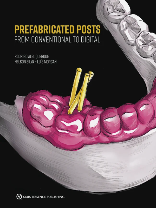 This concise and exquisitely illustrated book, based on the philosophy and clinical experience of its authors and on sound scientific evidence, is divided into 10 chapters in a didactic sequence to make it easier for dentists to apply the techniques in every day practice. The focus is on preserving the heathy tooth structure as much as possible using both conventional and digital methodologies.