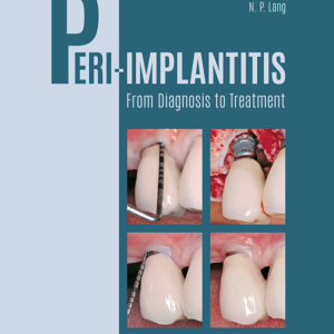 Peri-Implantitis: From Diagnosis to Treatment