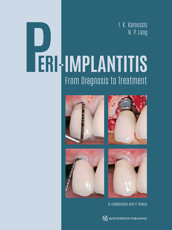 Peri-Implantitis: From Diagnosis to Treatment