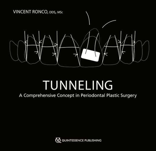 Tunneling A Comprehensive Concept in Periodontal Plastic Surgery