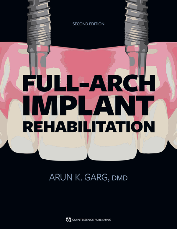 Full-Arch Implant Rehabilitation