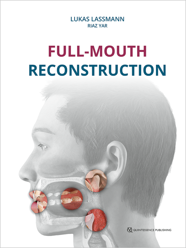 Full-Mouth Reconstruction